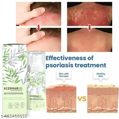 Eczemaron Herbal Anti Fungal Spray - (Buy 1 Get 1 FREE🔥🔥)
