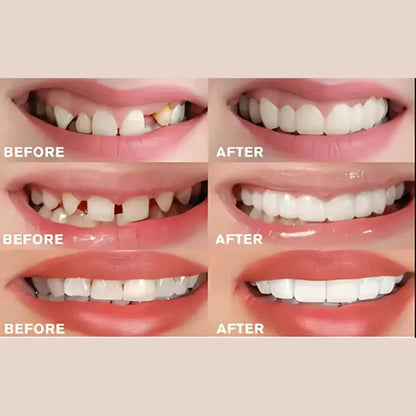 🔥Instant and Confident on Smile Fit Flex Cosmetic Teeth Denture Teeth🔥